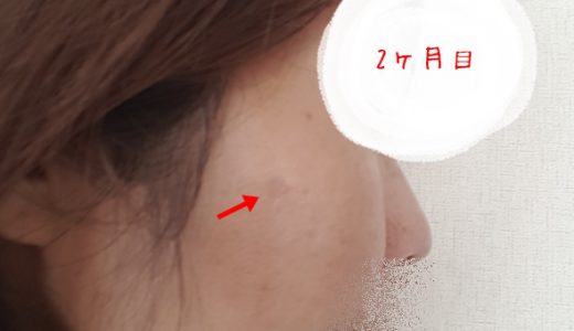 【２ヶ月目】ビーグレンしみケアチャレンジ